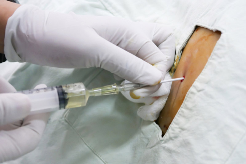 Primo piano di una siringa iniettata nell'addome di un paziente per svolgere la paracentesi