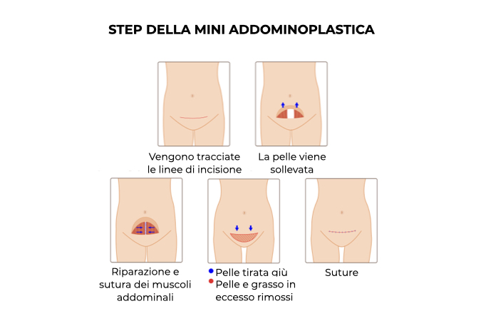 Illustrazione delle diverse fasi della mini addominoplastica