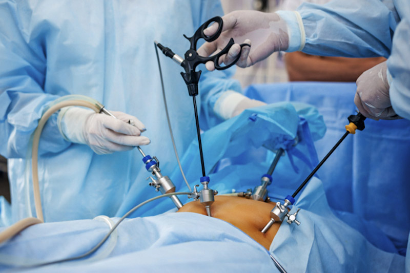 Primo piano di apparecchiature laparoscopiche utilizzate da due chirurghi in sala operatoria