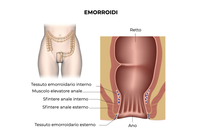 Illustrazione del retto di un paziente con emorroidi interne ed esterne