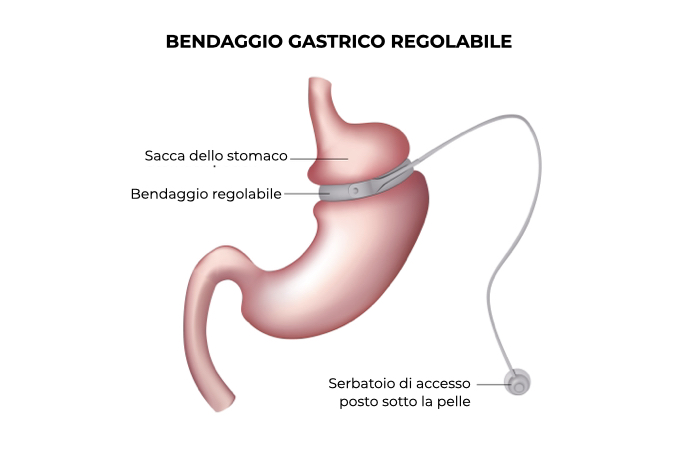 Illustrazione di uno stomaco con bendaggio gastrico regolabile