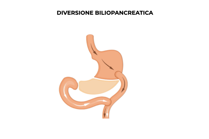 Illustrazione di uno stomaco con diversione biliopancreatica