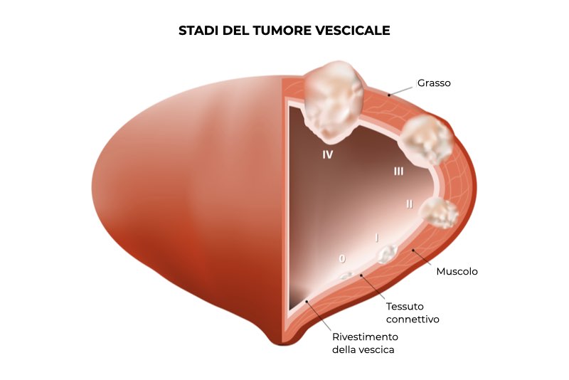 Illustrazione dei diversi stadi del tumore alla vescica