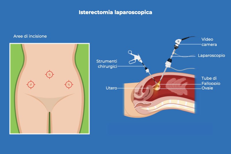 Illustrazione di come si esegue l'isterectomia laparoscopica