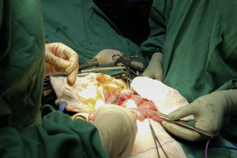 Operazione chirurgica di rimozione di tumore del colon tramite emicolectomia