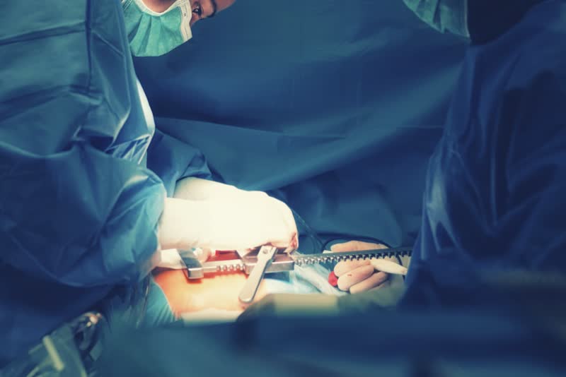 Equipe medica di chirurghi in ospedale che esegue un intervento di toracotomia