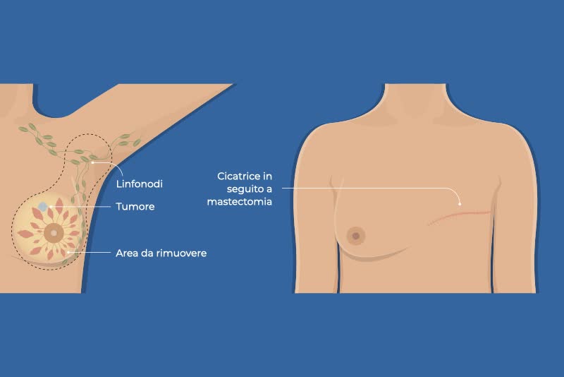 Illustrazione di un corpo femminile con tumore alla mammella prima e post operazione di mastectomia