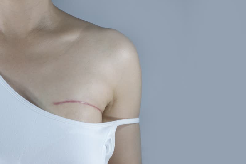 Foto di donna con spallina del vestito abbassata che mostra cicatrice all'altezza del seno sinistro risultato di un'operazione di quadrantectomia