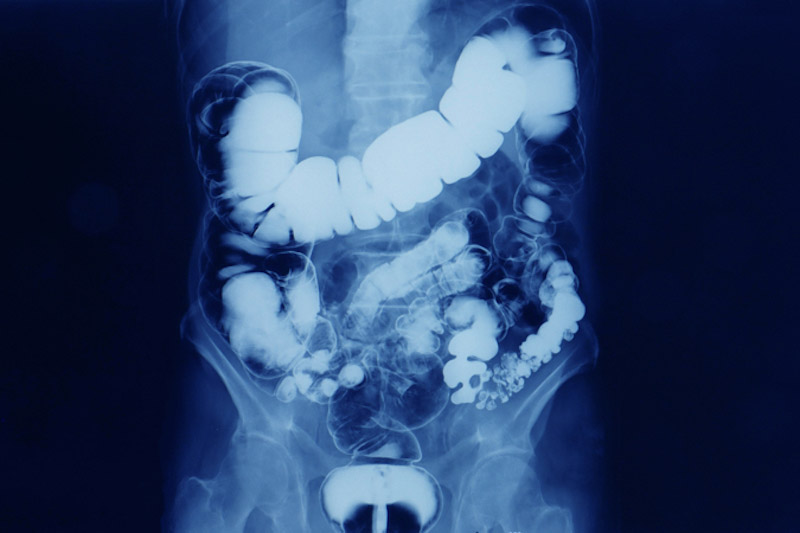 Radiografia che mostra il riempimento dell’intestino di un paziente attraverso il clistere di bario