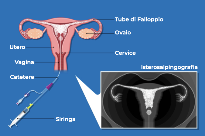 Illustrazione di una vagina e spiegazione di come avviene l'isterosalpingografia