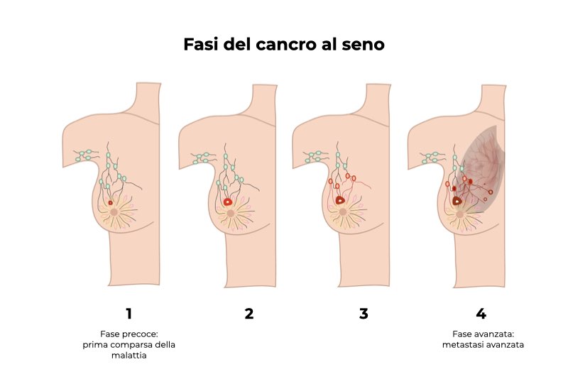 Illustrazione che rappresenta le varie fasi del cancro al seno, dalla fase precoce alla fase di metastasi avanzata, patologia per la quale si effettua la biopsia del linfonodo sentinella