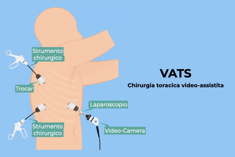 Illustrazione su sfondo azzurro della VATS (chirurgia toracica video-assistita o videotoracoscopia): si inserisce un laparoscopio grazie ad un trocar nel quale si inserisce a sua volta una video-camera per riprendere in diretta l'operazione dall'interno