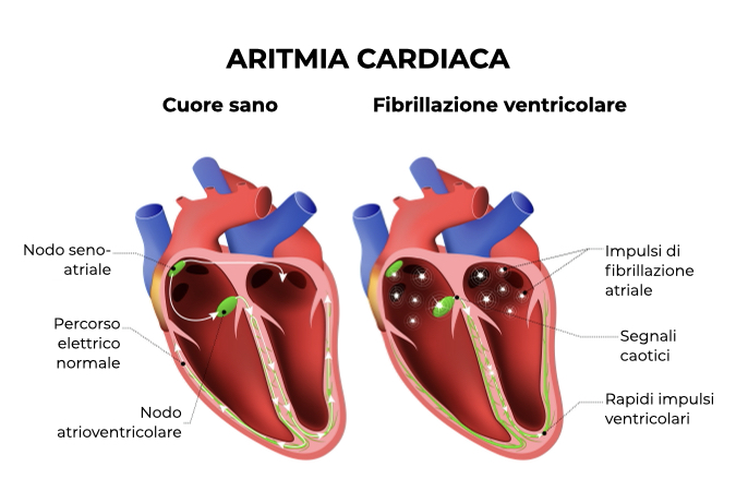 Illustrazione di un cuore sano a confronto con un cuore con rapidi impulsi ventricolari a causa della fibrillazione ventricolare