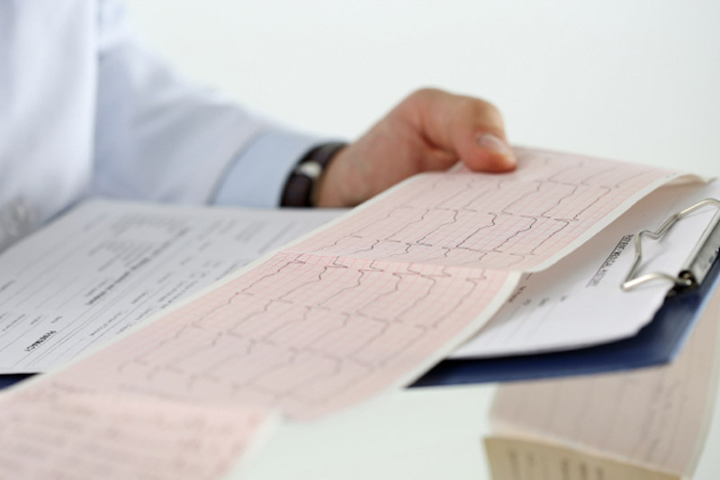 Primo piano delle mani di un medico maschio che tengono il grafico del cardiogramma di un paziente con tachicardia parossistica sopraventricolare su un blocco per appunti