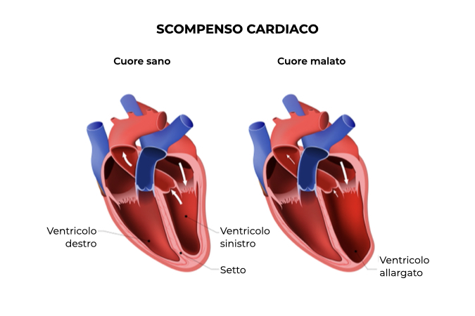 confronto fra cuore sano e con scompenso cardiaco