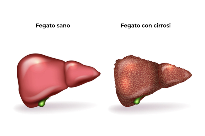 Illustrazione di un fegato sano e fegato con cirrosi a confronto