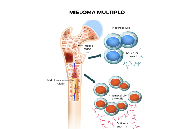 Illustrazione grafica di un osso umano danneggiato da cellule maligne per effetto del mieloma multiplo