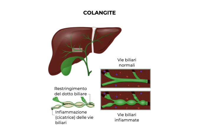 Illustrazione di fegato e vie biliari di un soggetto con colangite