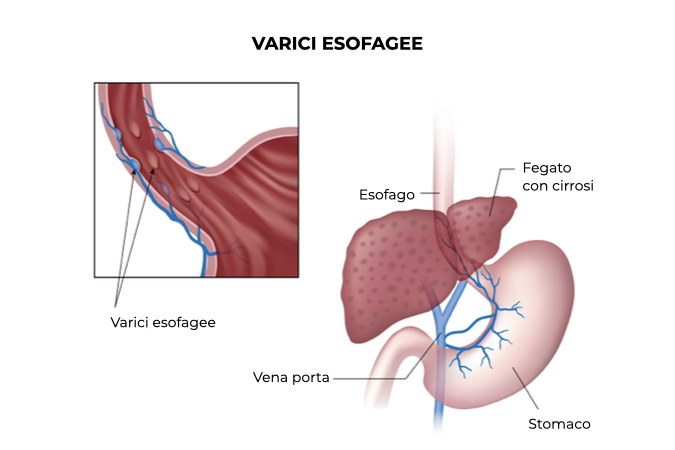 Illustrazione di un fegato con cirrosi e primo piano dell'esofago con varici