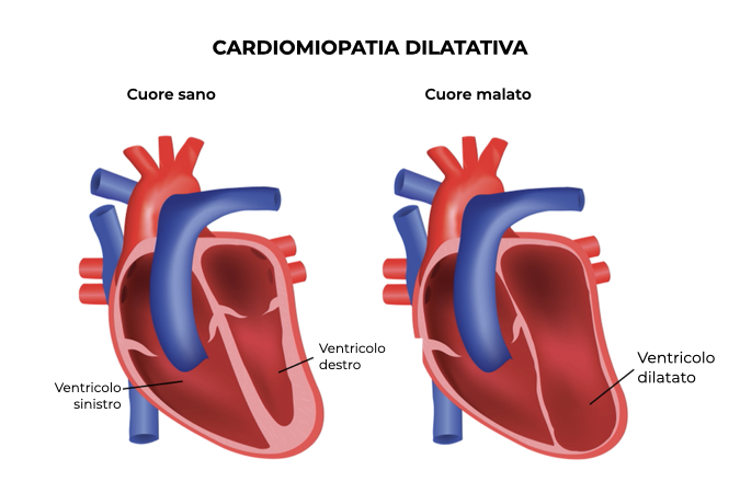 Illustrazione di un cuore sano e un cuore con ventricolo dilatato per cardiomiopatia dilatativa