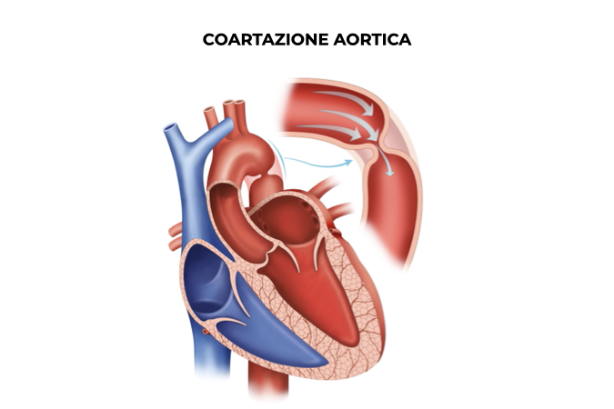 Illustrazione di un cuore con restringimento localizzato dell'aorta 