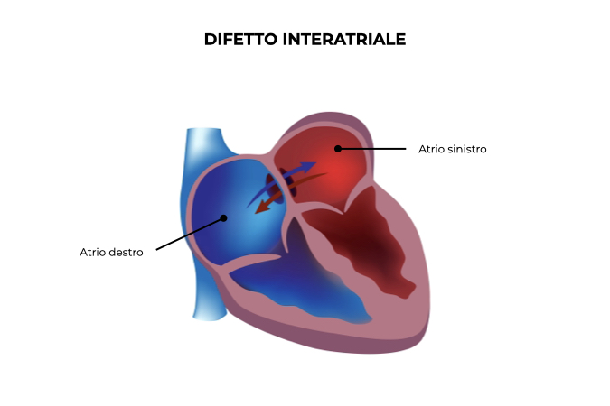 Illustrazione di un cuore con difetto dell'atrio destro e sinistro