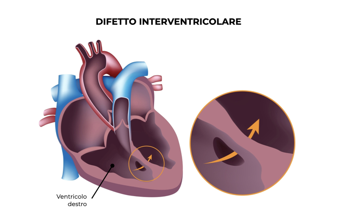 Illustrazione di un cuore con malformazione del ventricolo destro e sinistro 