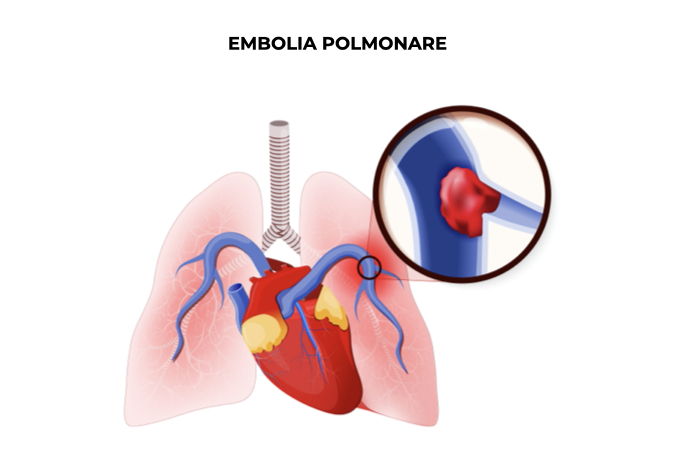 Illustrazione di un polmone con ostruzione di un vaso della circolazione arteriosa polmonare a causa di embolo embolia polmonare