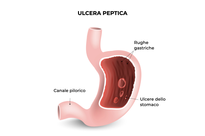 Illustrazione di uno stomaco con ulcera peptica