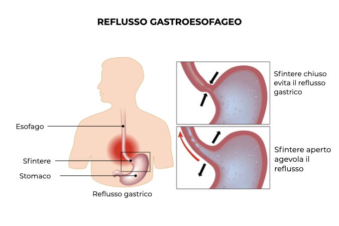 Illustrazione del reflusso gastroesofageo causato dall'apertura dello sfintere esofageo che provoca esofagite 