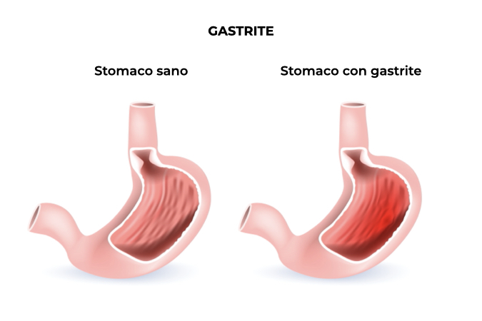 Illustrazione di uno stomaco sano a confronto con uno stomaco infiammato a causa della gastrite