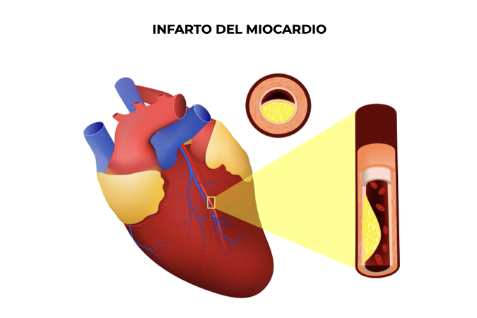 Illustrazione di un cuore con flusso sanguigno delle arterie bloccato da placche che portano all'infarto del miocardio