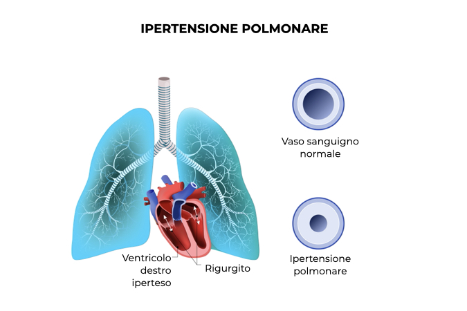 Illustrazione di un polmone con ipertensione dei vasi sanguigni polmonari