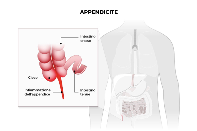 Illustrazione di un corpo umano con focus su appendice