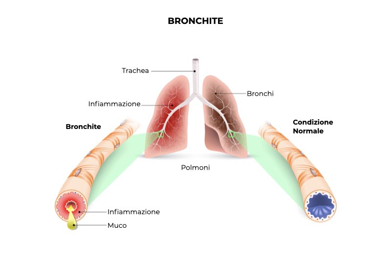 Illustrazione di un polmone con condizione normale e bronchite