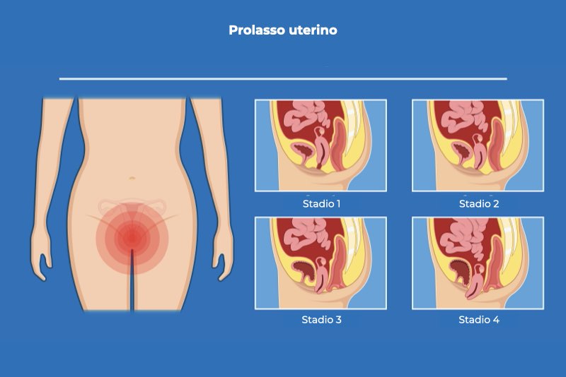 Illustrazione che mostra i diversi stadi del prolasso uterino