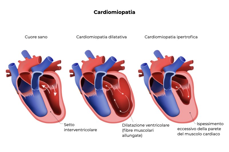 Illustrazione di tre cuori con diverse tipologie di cardiomiopatie