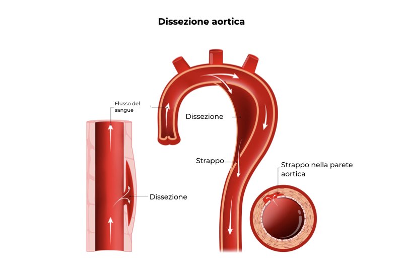 Illustrazione della dissezione aortica