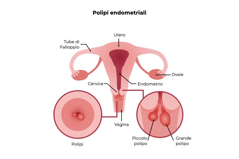 Illustrazione di una vagina con polipi endometriali