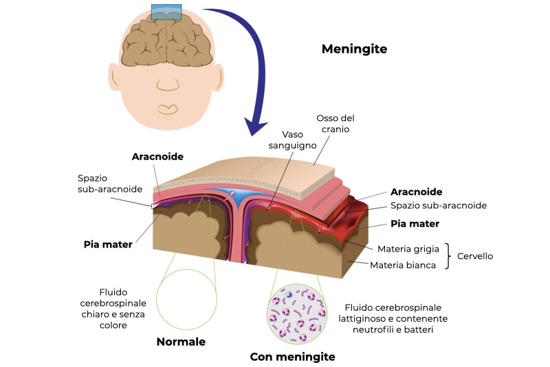 Illustrazione di spiegazione delle differenze tra meningi sane (con fluido cerebrospinale chiaro e senza colore) e con presenza di meningi (fluido lattiginoso con neutrofili e batteri)