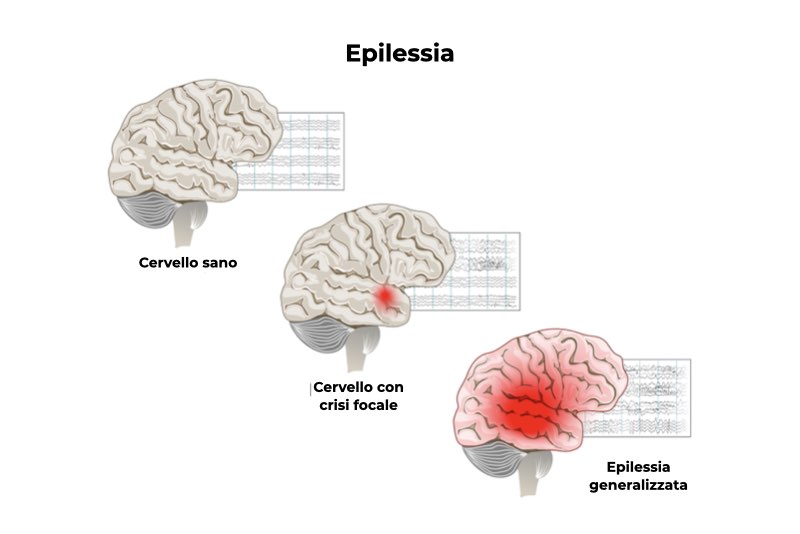 Illustrazione che rappresenta i diversi stadi un cervello sano, con crisi focale e epilessia generalizzata per rappresentare la patologia epilessia