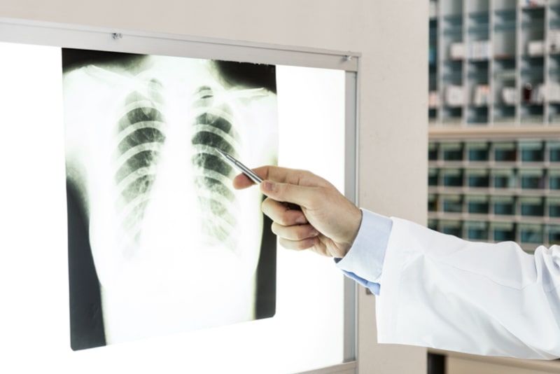 Medico che indica una radiografia dei polmoni indicando la presenza di polmonite lobulare, anche detta broncopolmonite