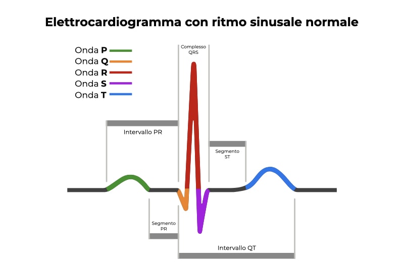 Elettrocardiogramma a ritmo sinusale normale con specifica su dove osservare l'intervallo QT per la diagnosi della Sindrome del QT lungo