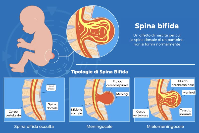 Illustrazione di un bambino con spina bifida e sue varie tipologie: spina bifida occulta, meningocele, mielomeningocele