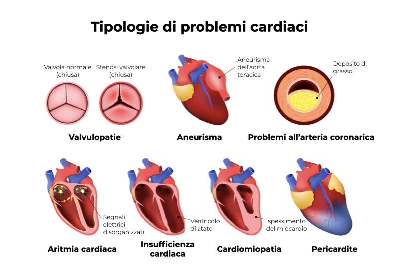 Illustrazione di cuori affetti da varie tipologie di problemi cardiaci, tra cui l'insufficienza cardiaca, causata dalla dilatazione dei ventricoli (ventricolo dilatato)