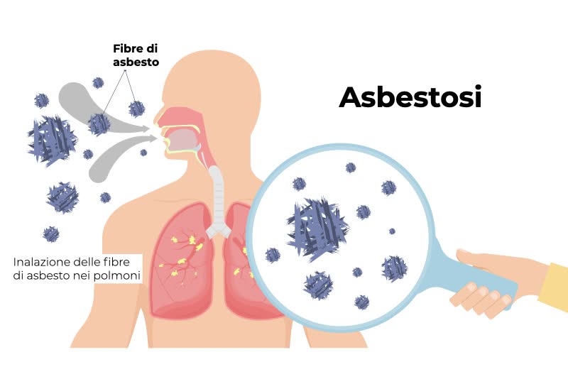 Illustrazione del processo di inalazione di fibre di asbesto che scatenano successivamente all'interno dei polmoni la patologia dell'asbestosi