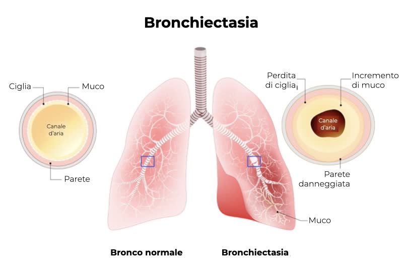 Illustrazione di due polmoni con bronchi sani e affetti da bronchiectasia, con spiegazione della patologia