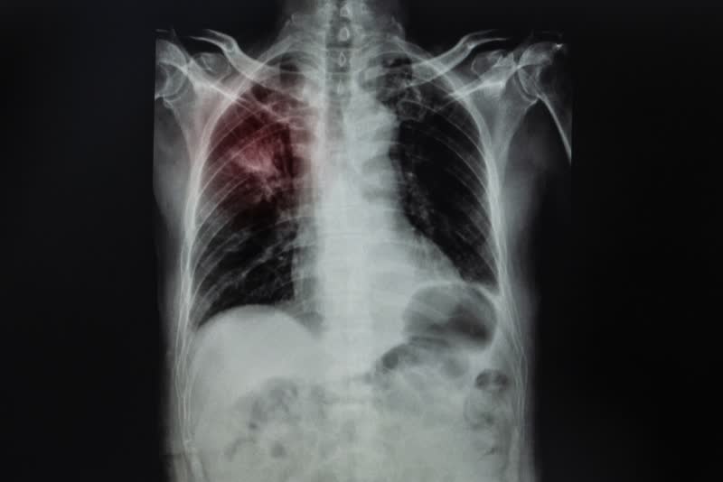 Immagine a raggi x di un torace con dei polmoni affetti dalla forma di pneumoconiosi chiamata silicosi