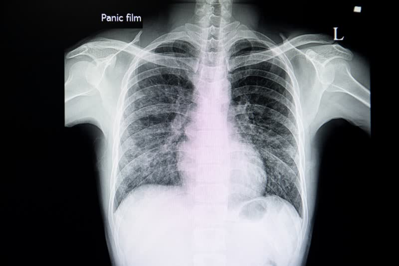 Immagine a raggi x di un paziente con interstiziopatia polmonare che coinvolge entrambe i polmoni