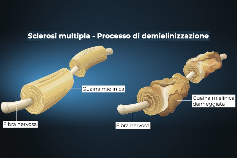 Illustrazione 3d di un nervo sano e un nervo danneggiato da un processo di demielinizzazione causato dalla sclerosi multipla